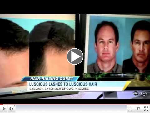 Latisse for Scalp Hair Growth_Good Morning America-ABC