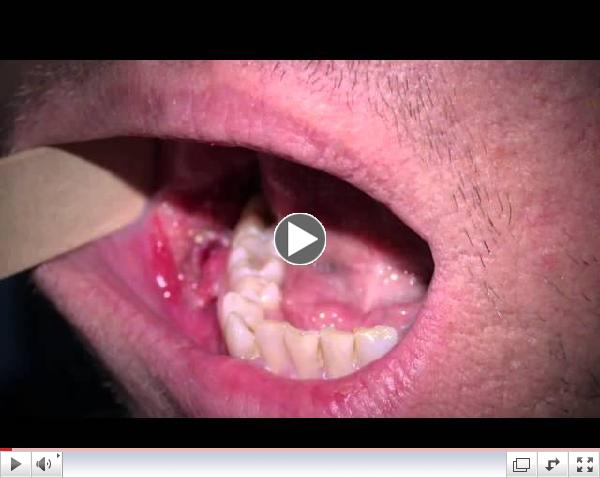Snapshot of HPV