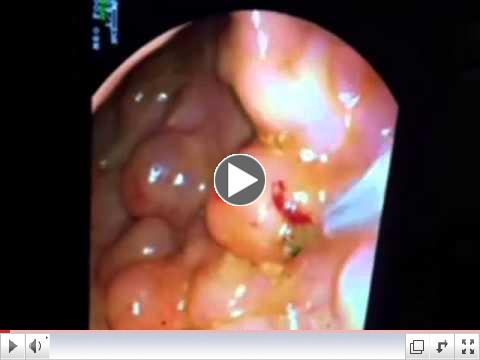 Pneumatosis Intestinalis