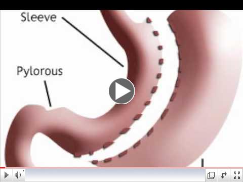 Gastric Sleeve  Dr Kuhn