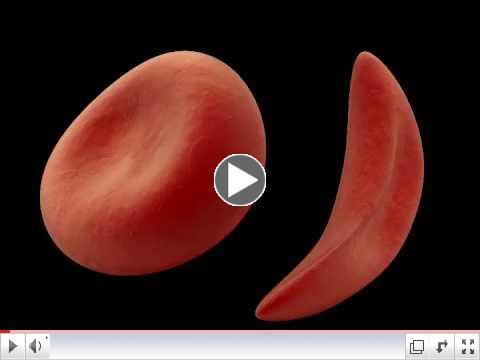 Two Additional Complications in Sickle Cell Anemia!