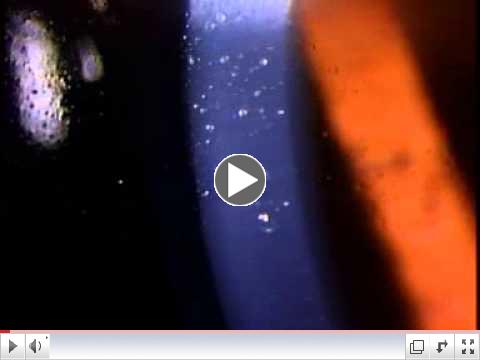 IACLE Case Report 3 - video 5 mucinballs