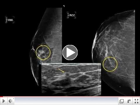 Digital Breast Tomosynthesis