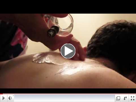 Lowell Sun Reporter getting a cupping treatment from Wellcare's Acupuncturist, Natalia Epstein