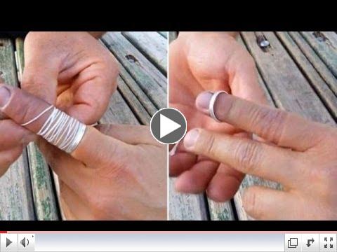 [FULL] How To Remove Ring Stuck On Finger | Ring Jammed On Finger Removed Using Piece Of String