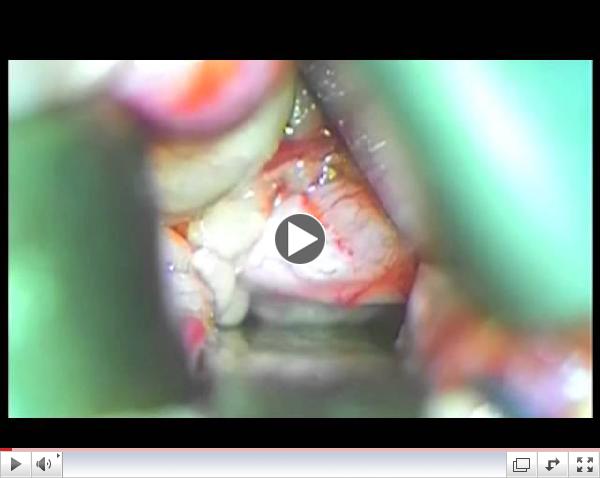 Optic Nerve Sheath Fenestration