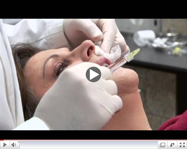 Lip Injections using Restylane Silk with Dr. Funk