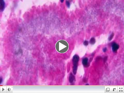 Nocardiosis: Nocardia asteroides