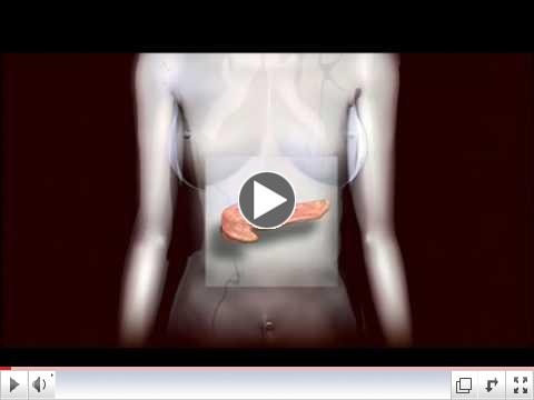 Diabetes Overview