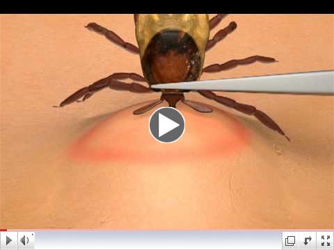 How To Remove A Tick