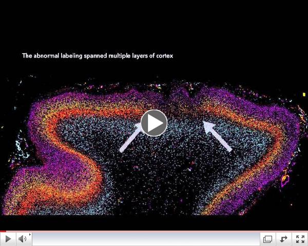 Patches of Disorganization in the Neocortex of Children with Autism