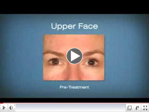 Capital City Cosmetic Surgyer- Ultherapy