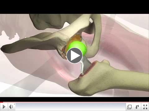 Anterior Approach Hip Replacement Surgery - DePuy Videos