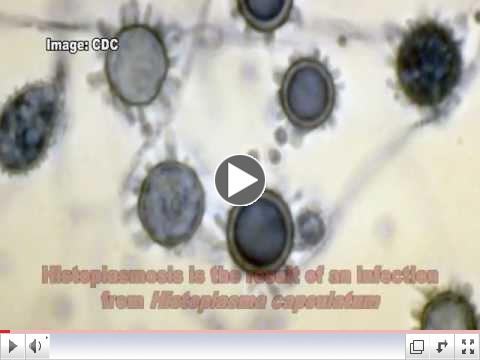 Histoplasma capsulatum & Histoplasmosis