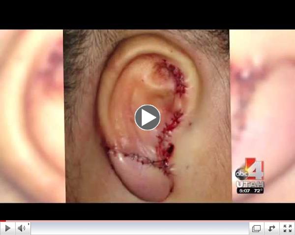 Utah's Top Facial Plastic Surgeon Helps Families in Need of Ear Surgery for Congenital Deformities