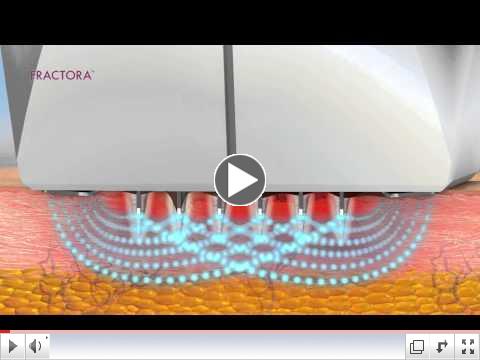 Anti-Aging Radiofrequency Treatment- Watch How Fractora Works