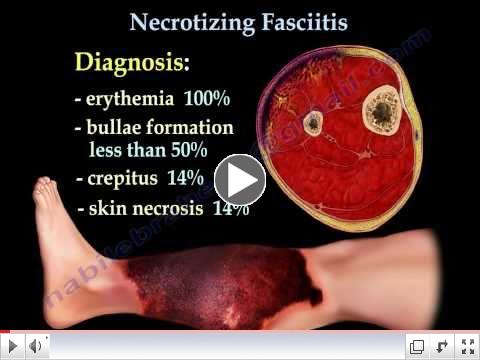 Necrotizing Fasciitis Part I