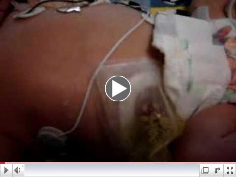 Necrotizing enterocolitis