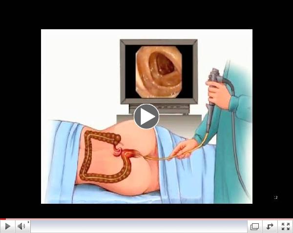 Irritable Bowel Syndrome