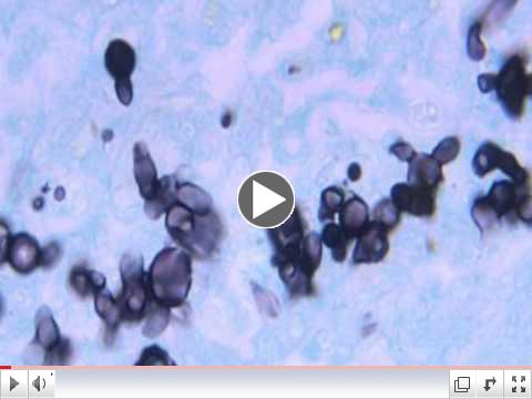Blastomycosis: Blastomyces dermatitidis