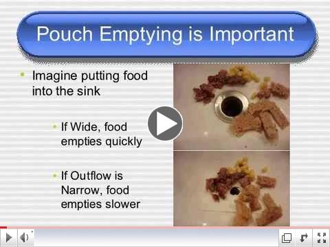 Sclerotherapy For Gastric Bypass Revision