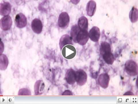 Pneumocystis Pneumonia & Pneumocystis Jirovecii