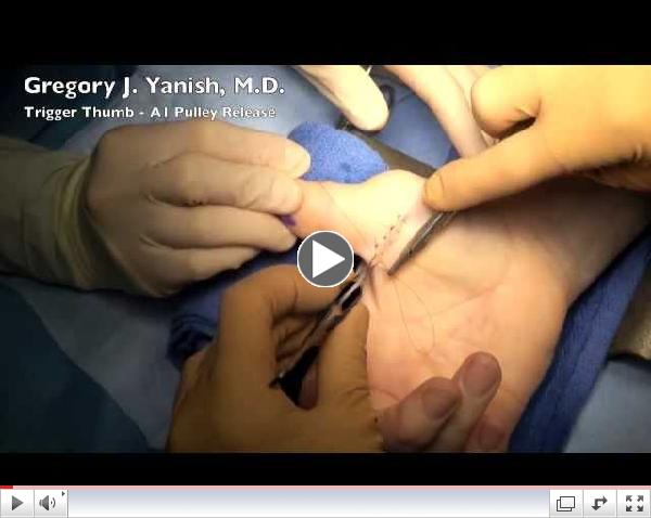 Trigger Thumb