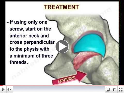 Treatment of slipped femoral epiphysis 