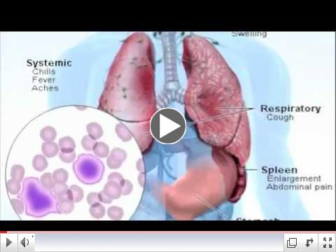 Mono Symptoms - What is Mononucleosis?