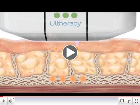 How Ultherapy Works