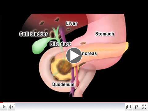 Pancreatic Cancer - About Pancreatic Cancer