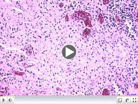 Typhoid Fever & Salmonella typhi