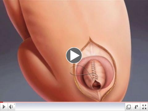 Postnatal Surgery for Spina Bifida - CHOP (9 of 12)