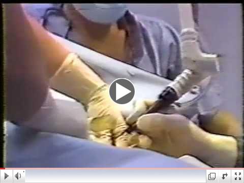 Laser Breast Cancer Surgery with Dr. Vincent Ansanelli