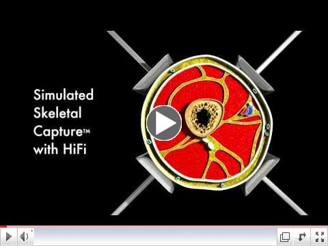 Above Knee Amputee Ali McWeeny in a HiFi Interface (Socket)