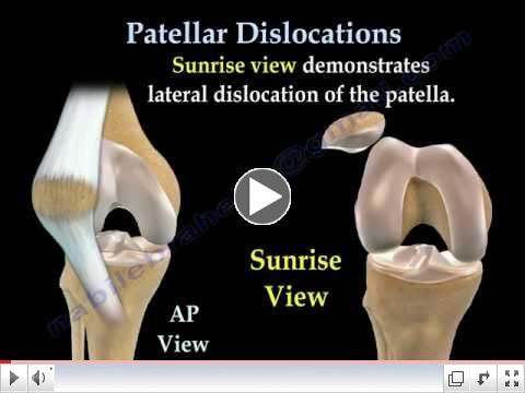 Patellar Dislocations