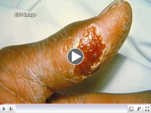 Tularemia and Francisella tularensis