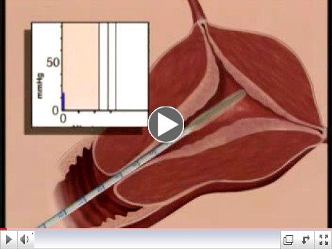 Thermachoice Video