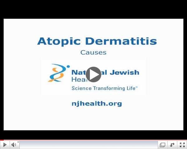 Atopic Dermatitis: Causes
