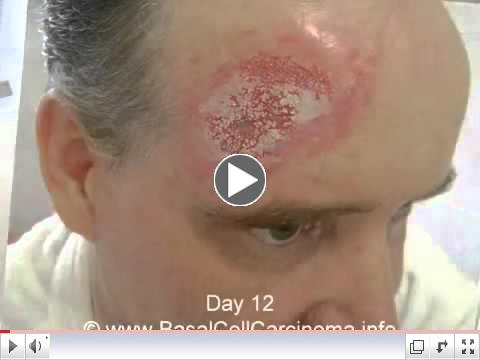 Curaderm BEC5 removes Basal Cell Carcinoma Video 2011